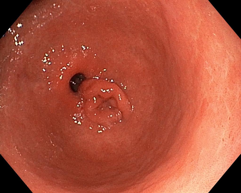 Аберрантная поджелудочная железа (pancreas accessorium). Атлас эндоскопических изображений endoatlas